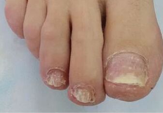 Mycosis of the nails causing trouble