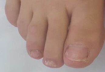 Promicil cures late-stage nail fungus