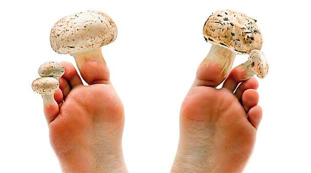 Toenail fungus is preventable