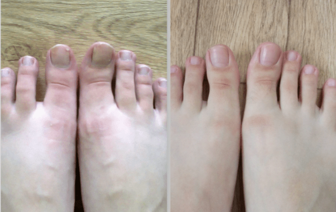 Before and after toenail fungus treatment