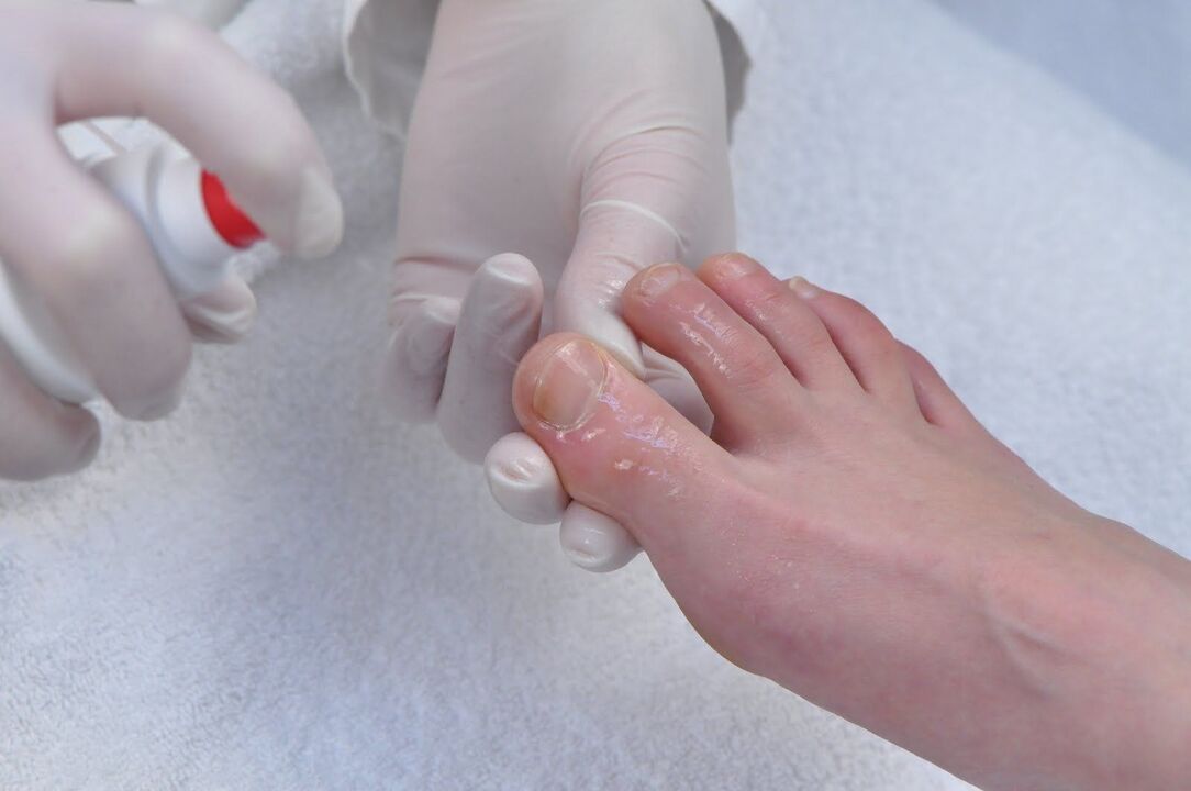 Hydrogen peroxide treats nail fungus