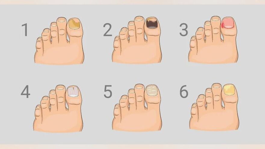 Main signs of foot fungus