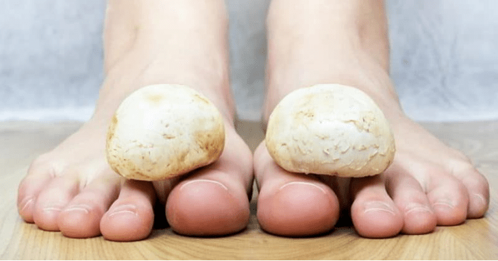 Fast treatment of mushrooms on feet at home