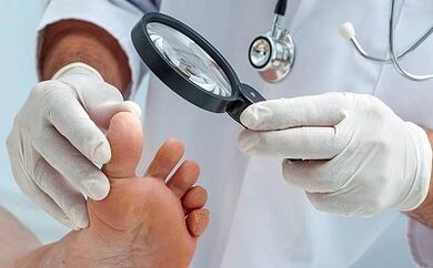 How to remove your nail mushroom