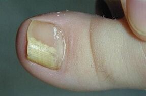 Reasons for the appearance of mushrooms on the thumb of the leg