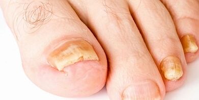 How and how to cure nail mushrooms