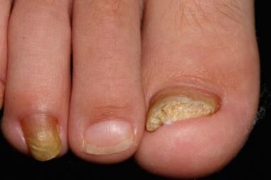 Micosis of nails on feet