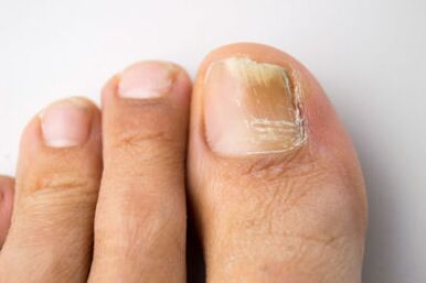 Mycosis is caused by yeast microorganisms