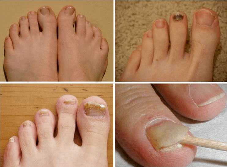 Signs of nail mushrooms