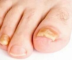 Nail fungus