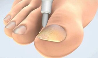 nail fungus removal collection