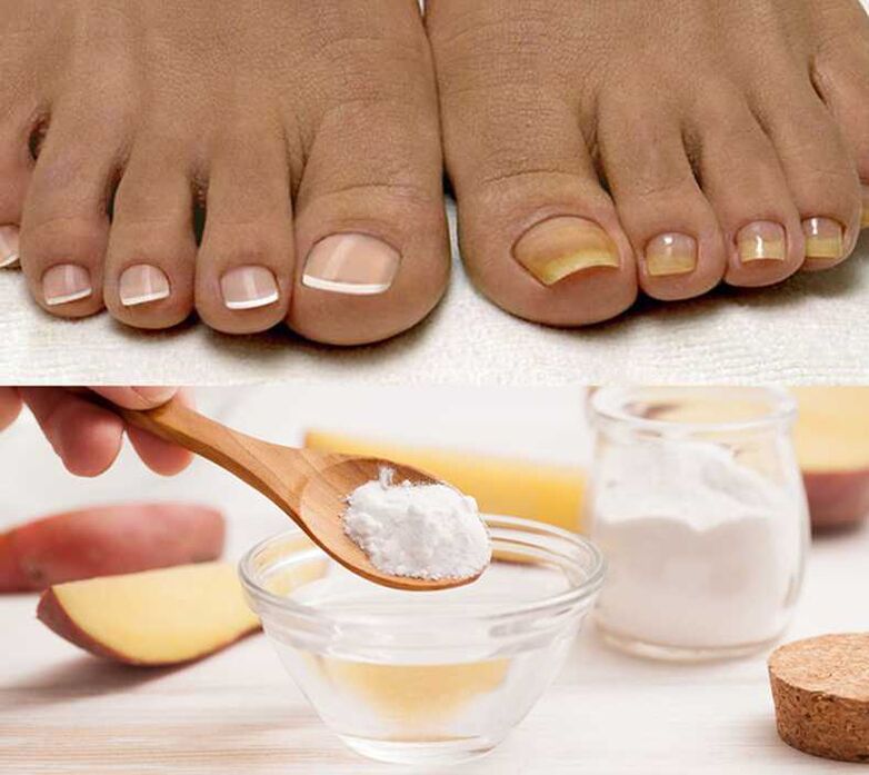 Soda treats nail fungus