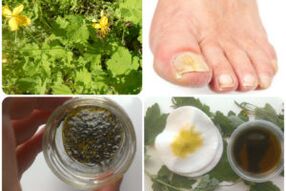 Folk remedies to treat toenail fungus