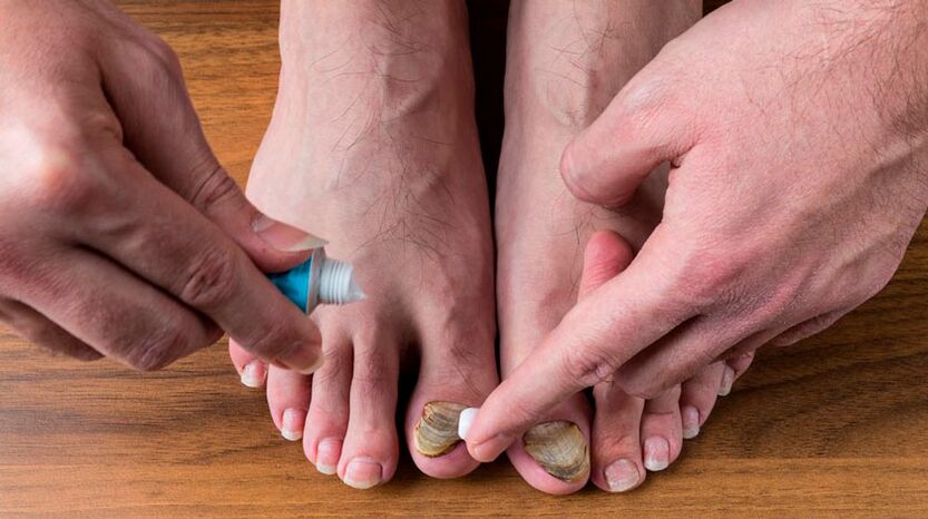 Apply antifungal cream to your toenails to treat nail fungus